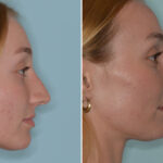 Rhinoplasty Before and After Photos in Miami, FL, Patient 8108