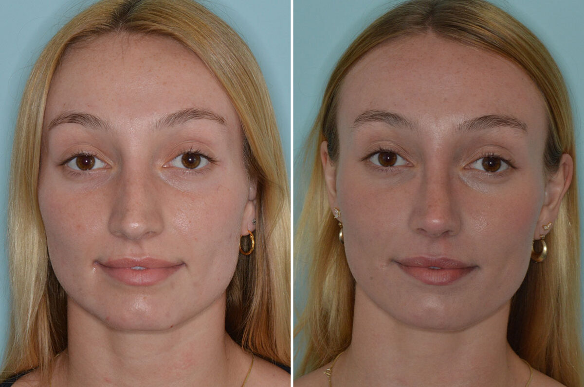 Rhinoplasty Before and After Photos in Miami, FL, Patient 8108