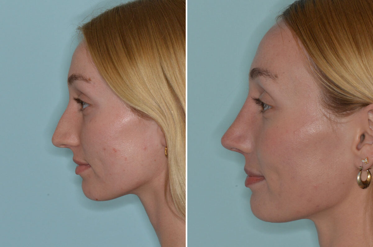 Rhinoplasty Before and After Photos in Miami, FL, Patient 8108