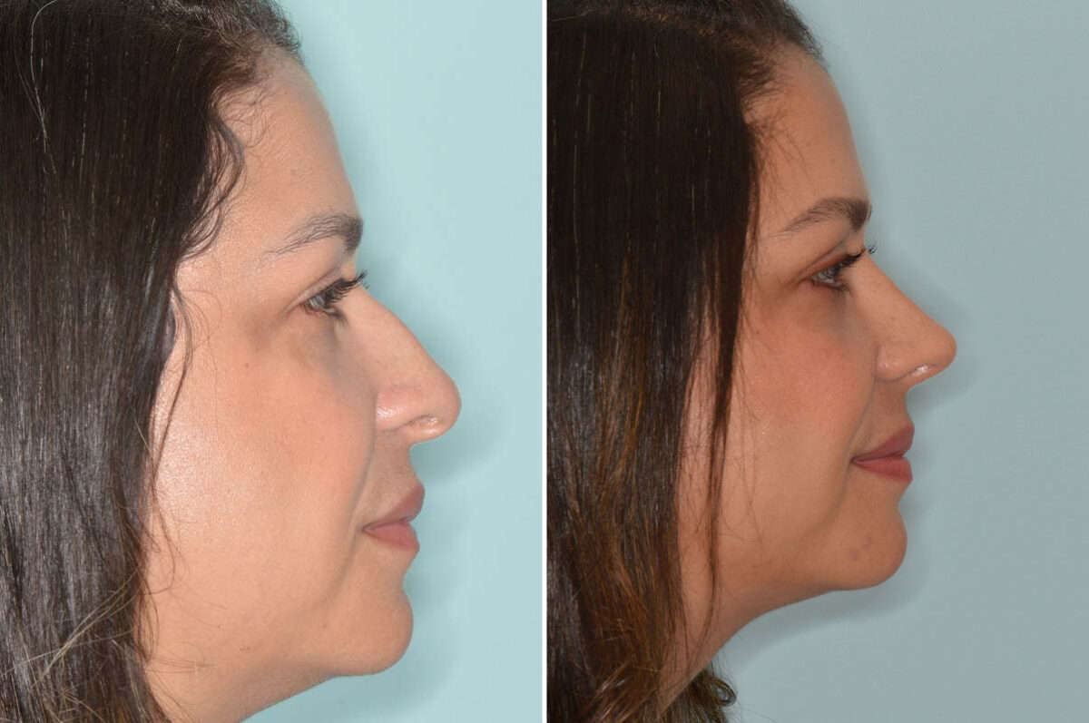 Ethnic Rhinoplasty Before and After Photos in Miami, FL, Patient 8118