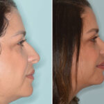 Ethnic Rhinoplasty Before and After Photos in Miami, FL, Patient 8118