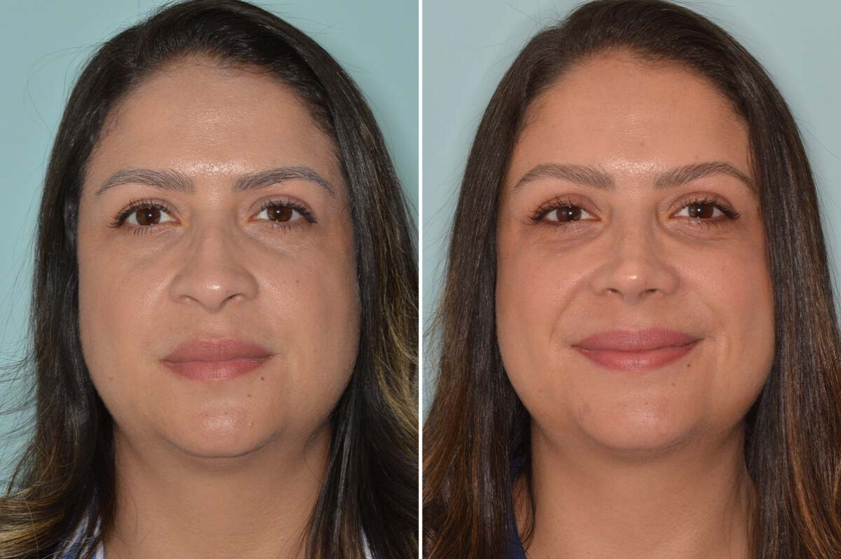 Ethnic Rhinoplasty Before and After Photos in Miami, FL, Patient 8118