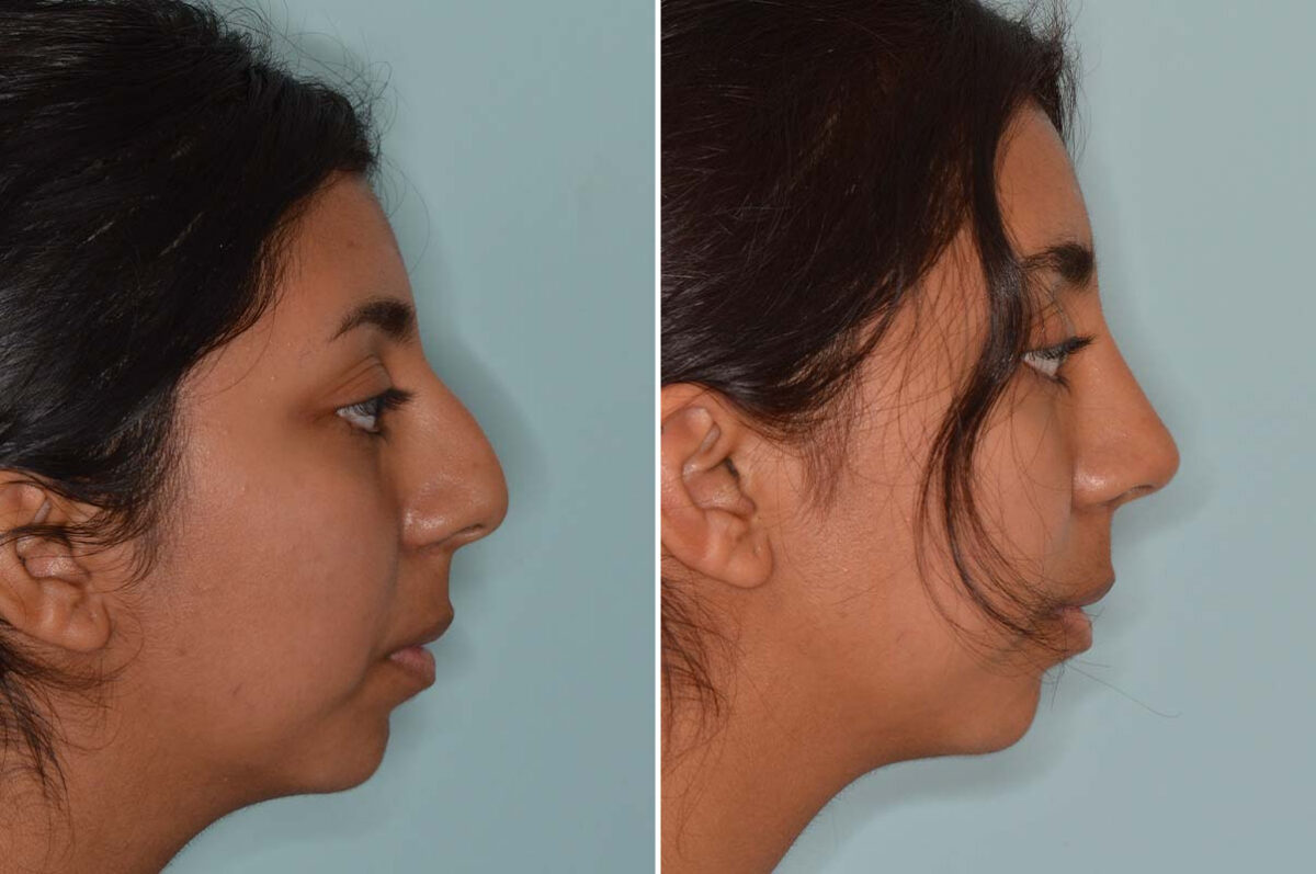 Ethnic Rhinoplasty Before and After Photos in Miami, FL, Patient 8125