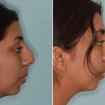 Ethnic Rhinoplasty Before and After Photos in Miami, FL, Patient 8125