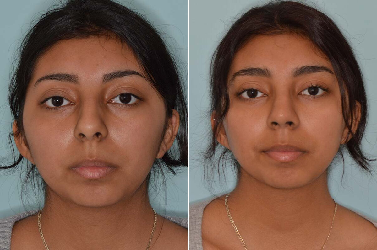 Ethnic Rhinoplasty Before and After Photos in Miami, FL, Patient 8125