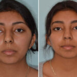 Ethnic Rhinoplasty Before and After Photos in Miami, FL, Patient 8125