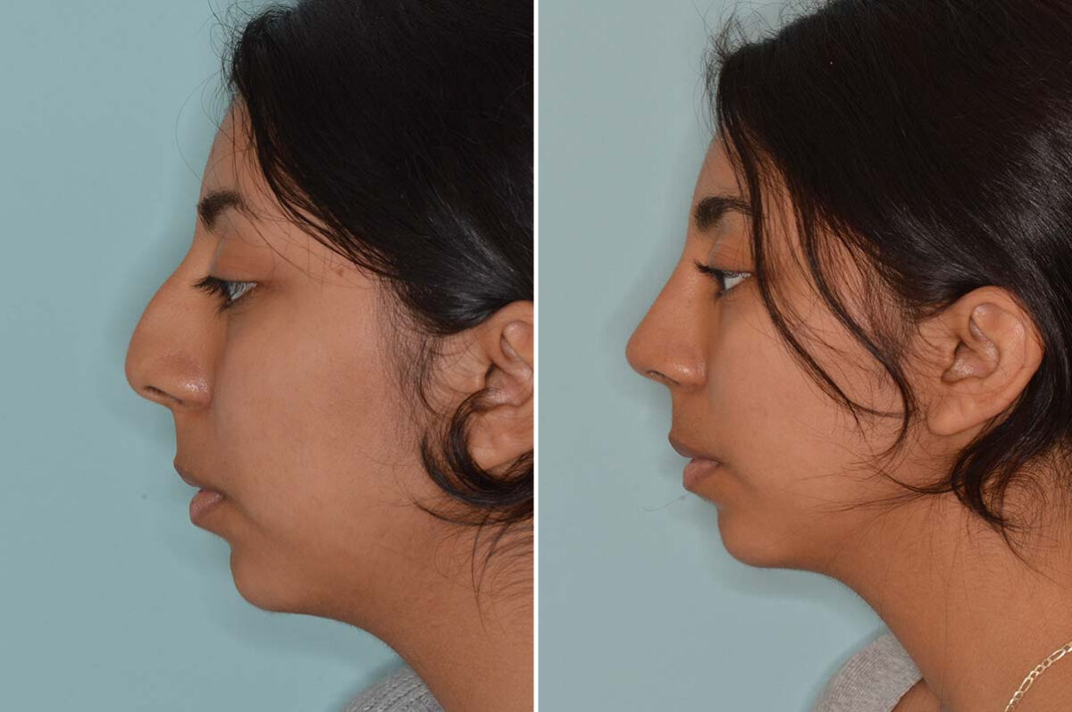 Ethnic Rhinoplasty Before and After Photos in Miami, FL, Patient 8125