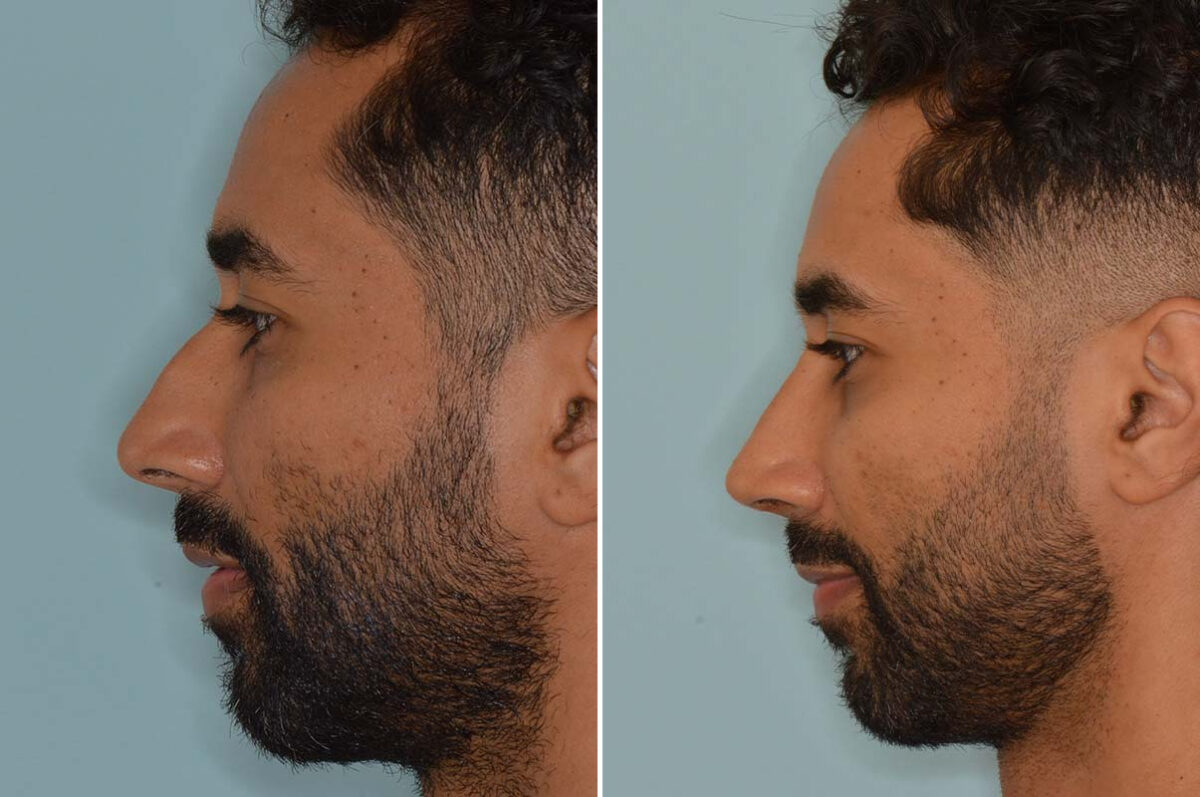 Ethnic Rhinoplasty Before and After Photos in Miami, FL, Patient 8135