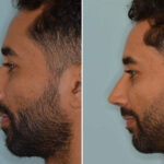 Ethnic Rhinoplasty Before and After Photos in Miami, FL, Patient 8135