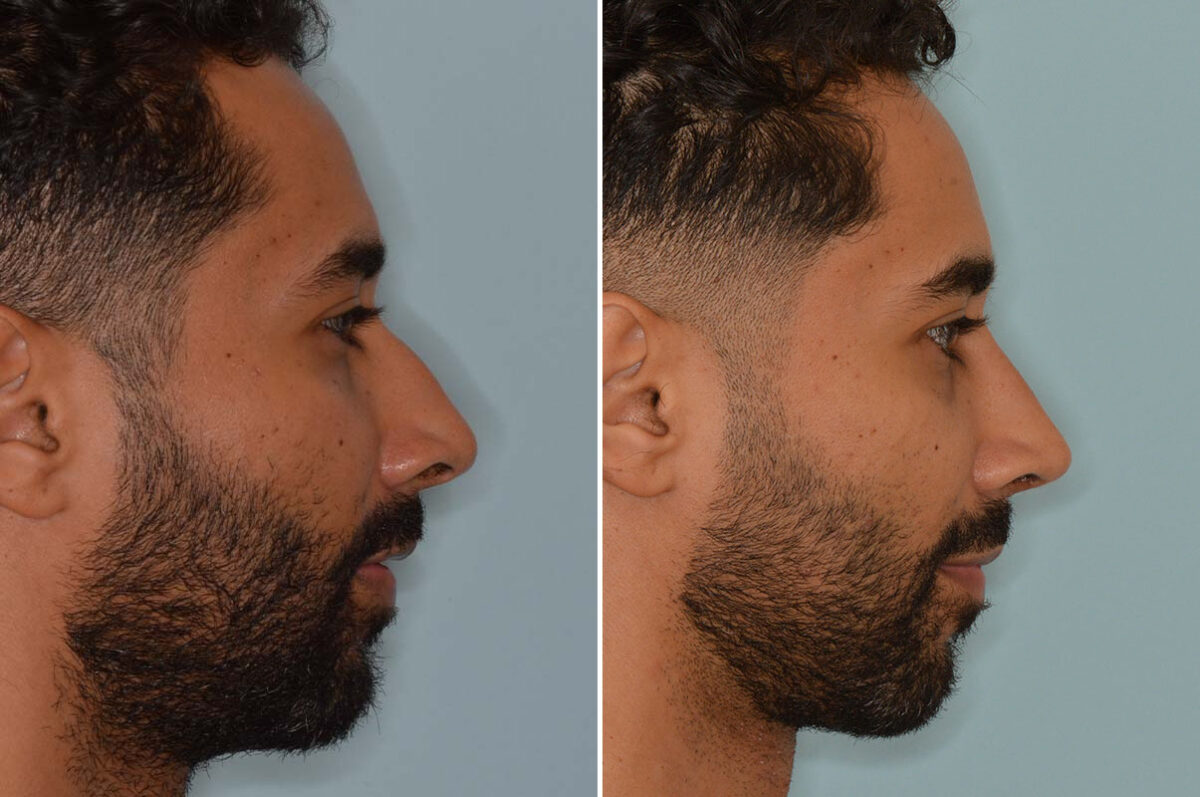 Ethnic Rhinoplasty Before and After Photos in Miami, FL, Patient 8135