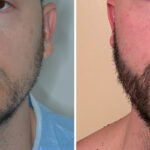 Beard Transplant Before and After Photos in Miami, FL, Patient 8145