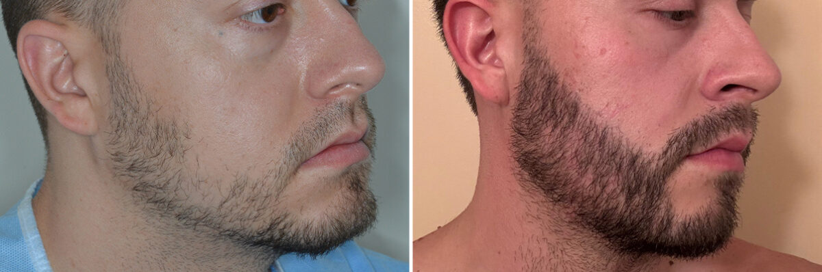 Beard Transplant Before and After Photos in Miami, FL, Patient 8145