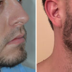 Beard Transplant Before and After Photos in Miami, FL, Patient 8145