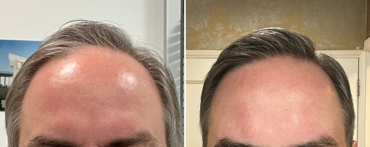 Hair Transplant Before and After Photos in Miami, FL, Patient 8159