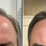 Hair Transplant Before and After Photos in Miami, FL, Patient 8159