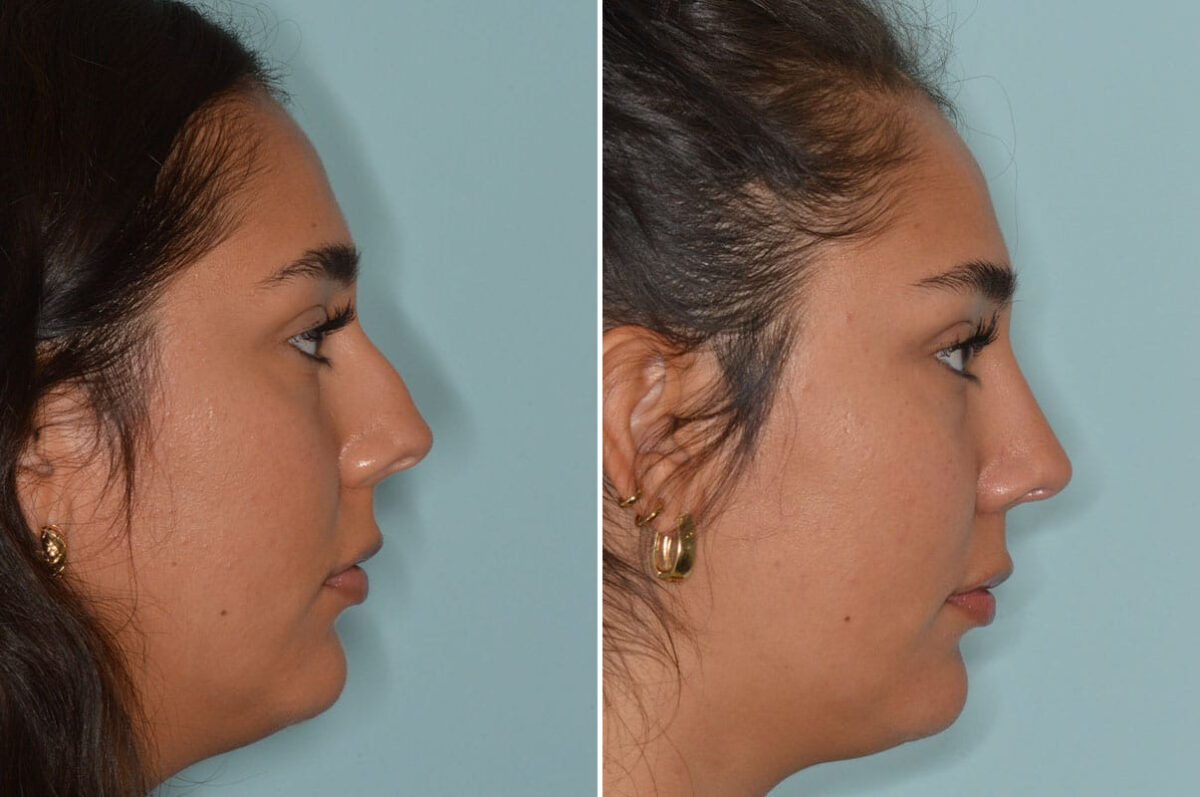 Rhinoplasty Before and After Photos in Miami, FL, Patient 8237