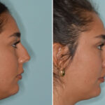 Rhinoplasty Before and After Photos in Miami, FL, Patient 8237