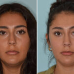 Rhinoplasty Before and After Photos in Miami, FL, Patient 8237