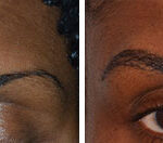 Eyebrow Transplant Before and After Photos in Miami, FL, Patient 8244