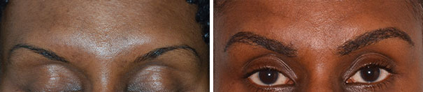 Eyebrow Transplant Before and After Photos in Miami, FL, Patient 8244