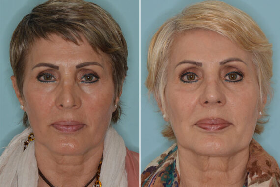 Revision Rhinoplasty Before and After Photos in Miami, FL, Patient 8255