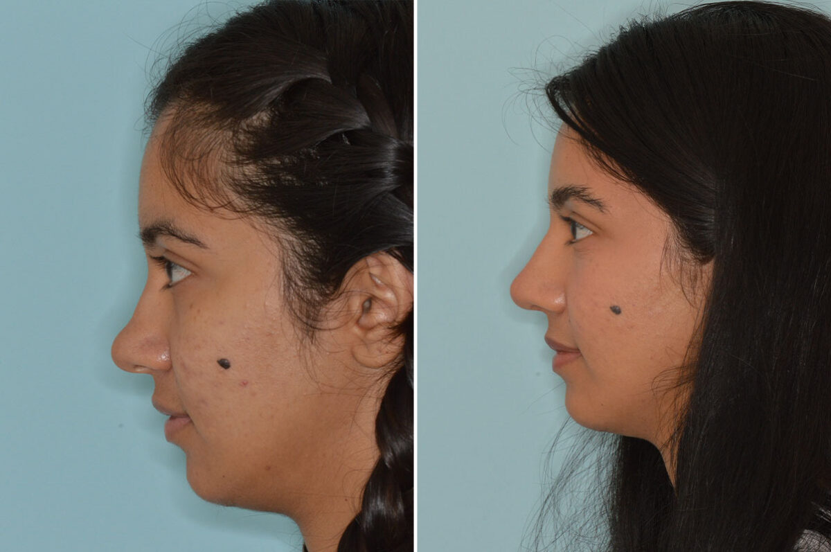 Ethnic Rhinoplasty Before and After Photos in Miami, FL, Patient 8262