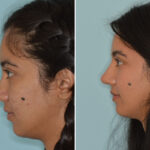 Ethnic Rhinoplasty Before and After Photos in Miami, FL, Patient 8262