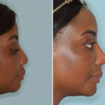 Ethnic Rhinoplasty Before and After Photos in Miami, FL, Patient 8269