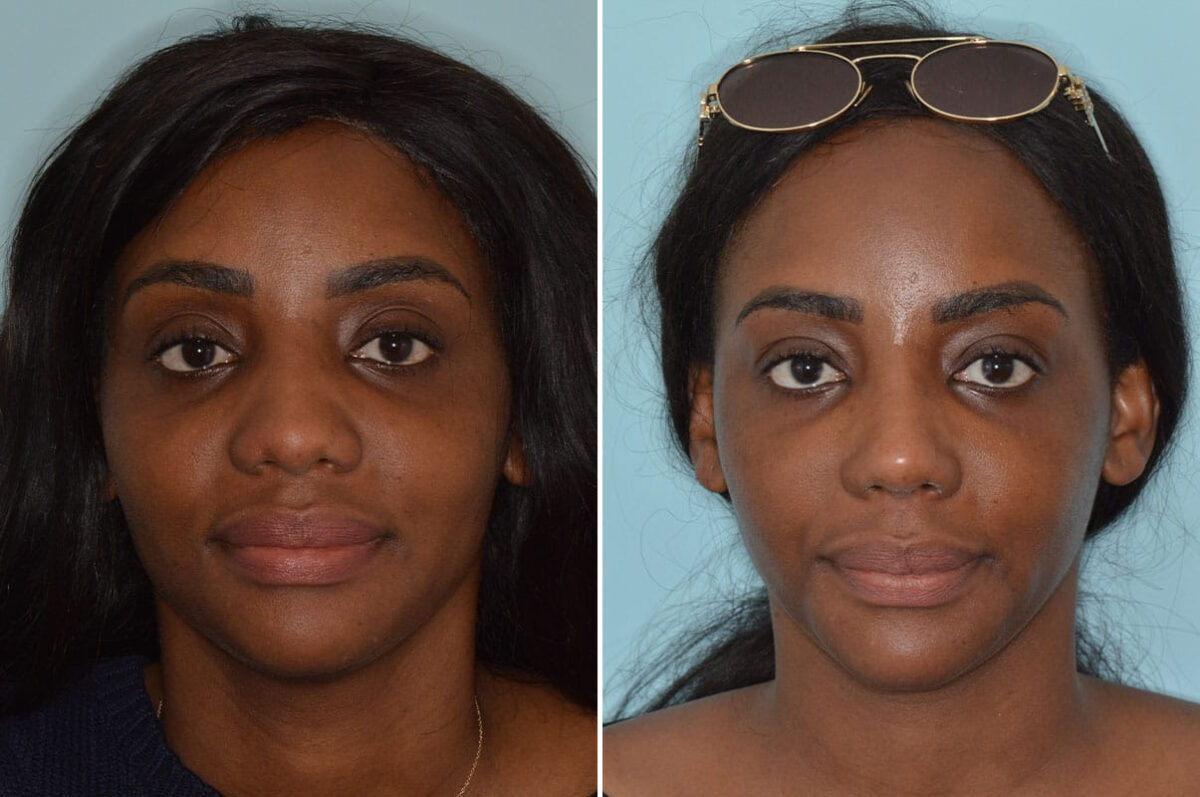 Ethnic Rhinoplasty Before and After Photos in Miami, FL, Patient 8269