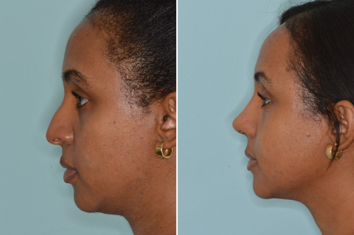 Ethnic Rhinoplasty Before and After Photos in Miami, FL, Patient 8276