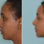 Ethnic Rhinoplasty Before and After Photos in Miami, FL, Patient 8276