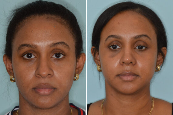 Ethnic Rhinoplasty Before and After Photos in Miami, FL, Patient 8276