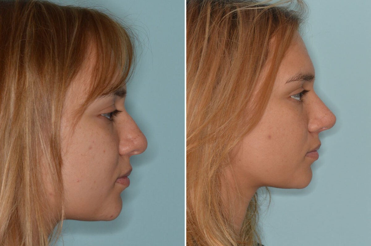 Ethnic Rhinoplasty Before and After Photos in Miami, FL, Patient 8286