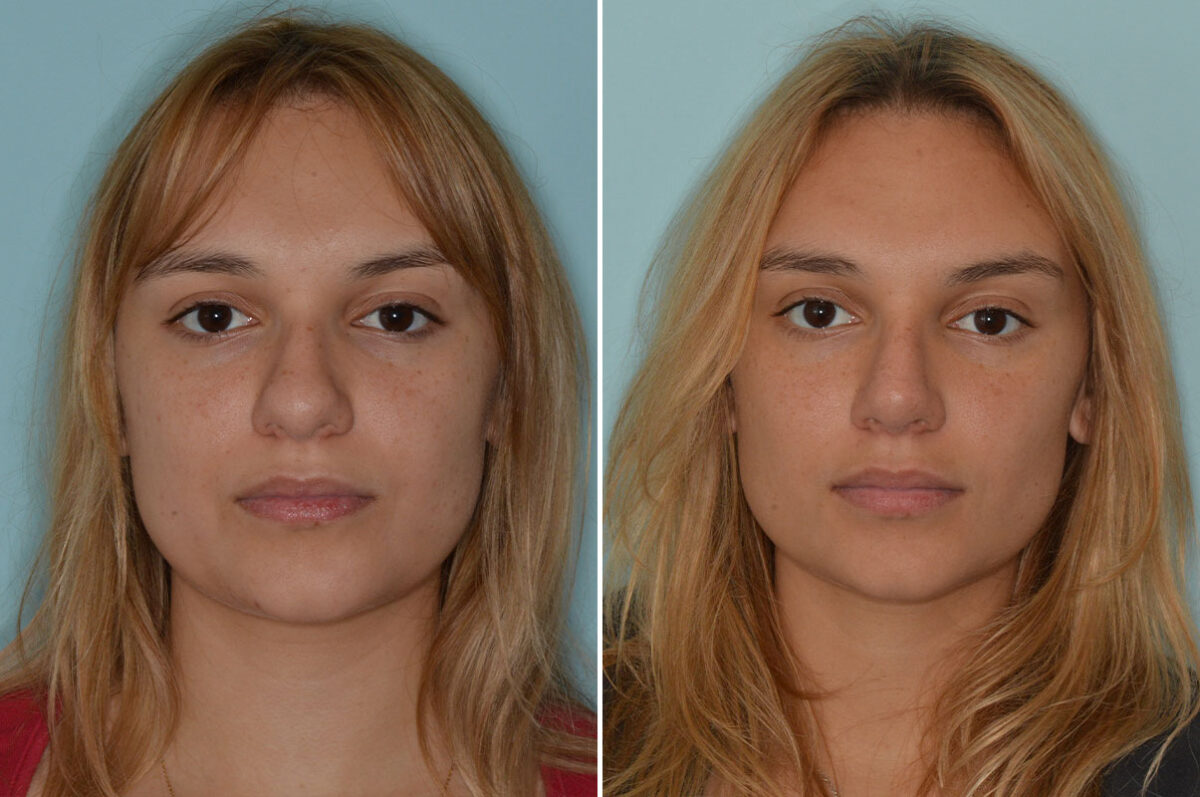 Ethnic Rhinoplasty Before and After Photos in Miami, FL, Patient 8286