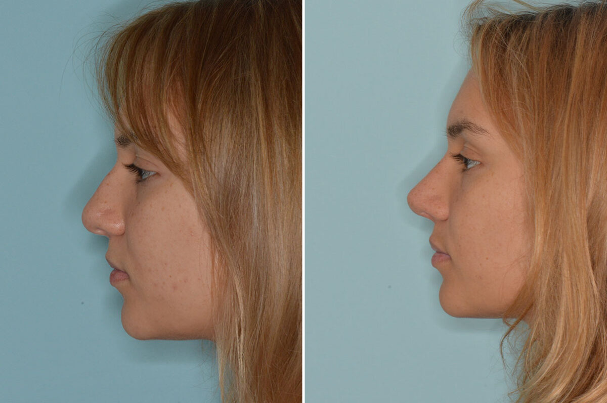 Ethnic Rhinoplasty Before and After Photos in Miami, FL, Patient 8286