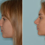 Ethnic Rhinoplasty Before and After Photos in Miami, FL, Patient 8286