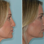 Rhinoplasty Before and After Photos in Miami, FL, Patient 8296