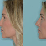 Rhinoplasty Before and After Photos in Miami, FL, Patient 8296