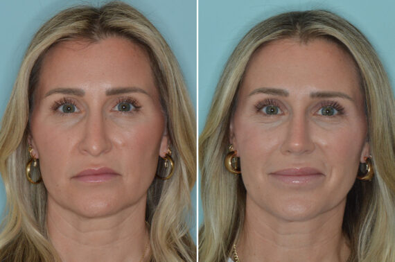 Rhinoplasty Before and After Photos in Miami, FL, Patient 8296