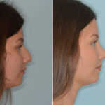 Rhinoplasty Before and After Photos in Miami, FL, Patient 8306