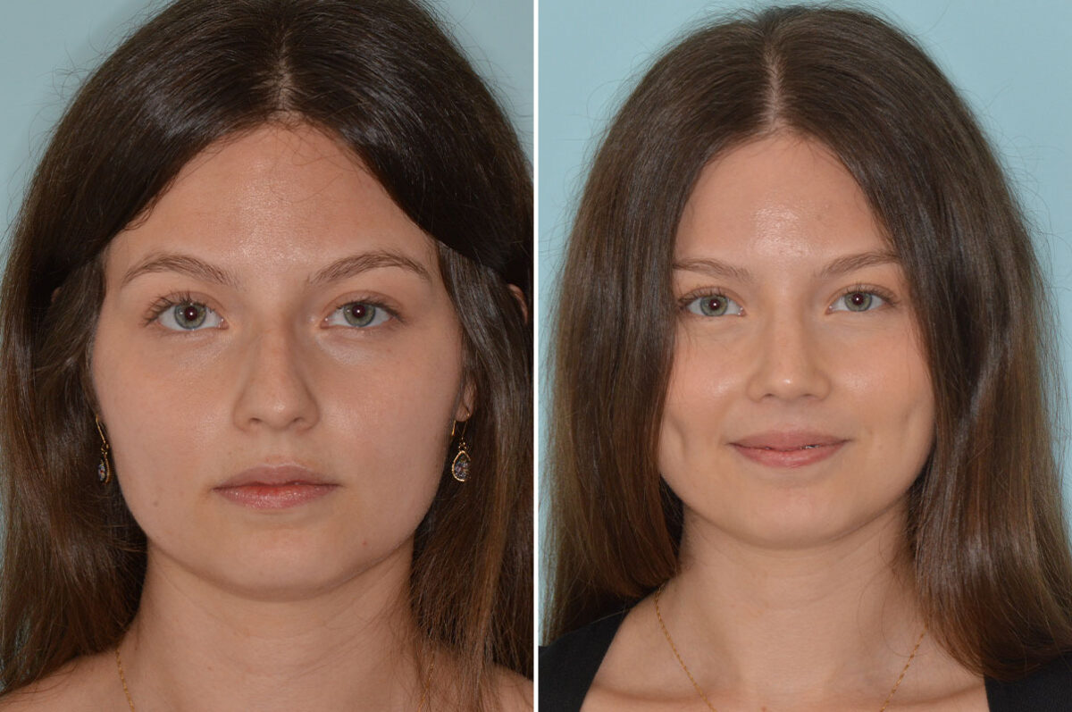 Rhinoplasty Before and After Photos in Miami, FL, Patient 8306