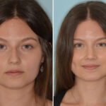 Rhinoplasty Before and After Photos in Miami, FL, Patient 8306