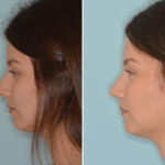 Rhinoplasty Before and After Photos in Miami, FL, Patient 8306