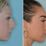 Rhinoplasty Before and After Photos in Miami, FL, Patient 8327