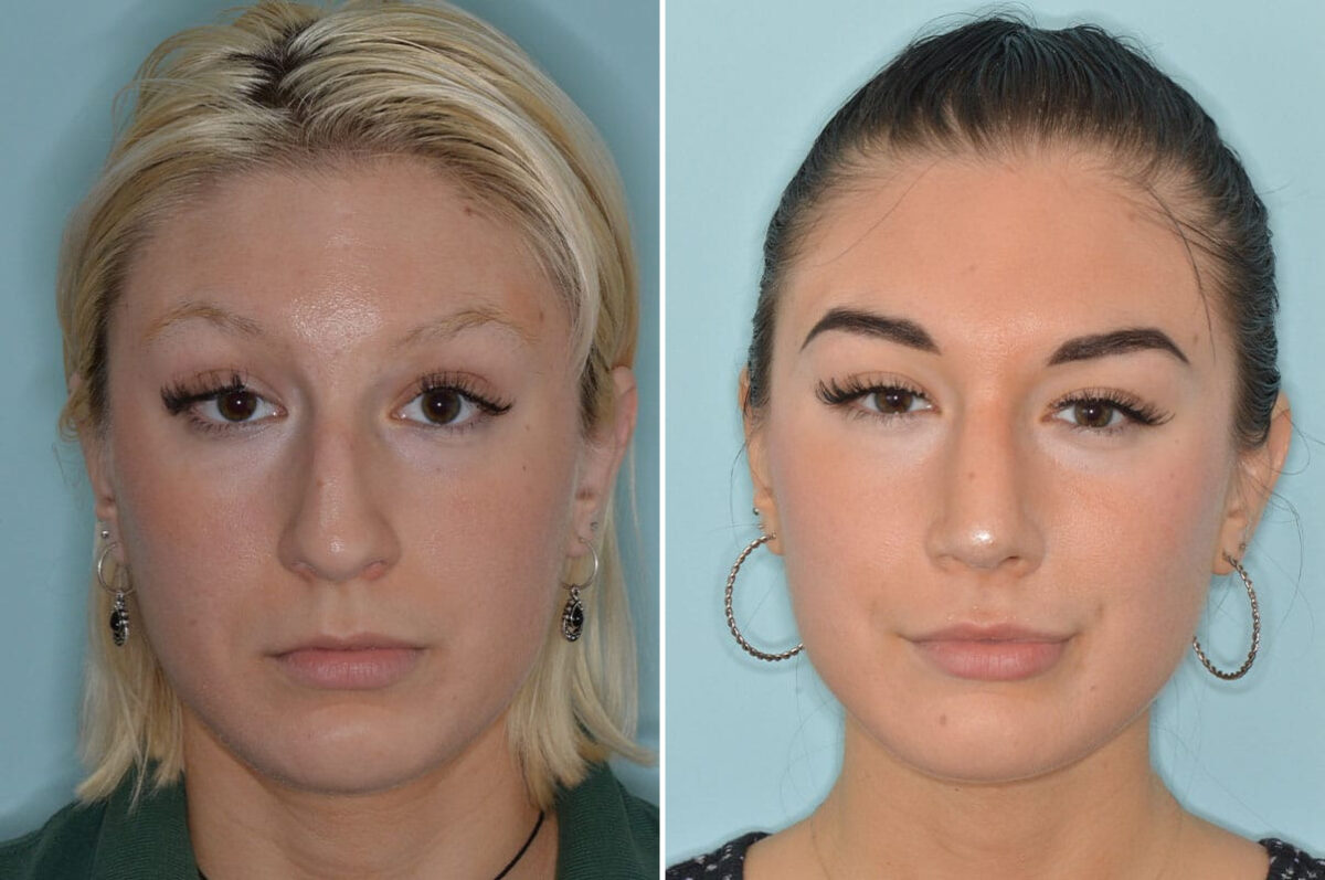 Rhinoplasty Before and After Photos in Miami, FL, Patient 8327