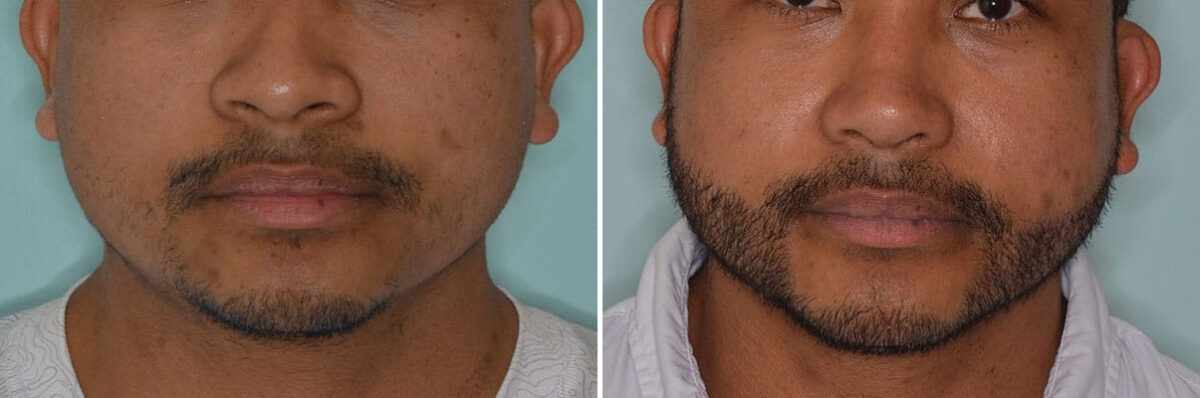 Beard Transplant Before and After Photos in Miami, FL, Patient 8354