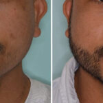 Beard Transplant Before and After Photos in Miami, FL, Patient 8354