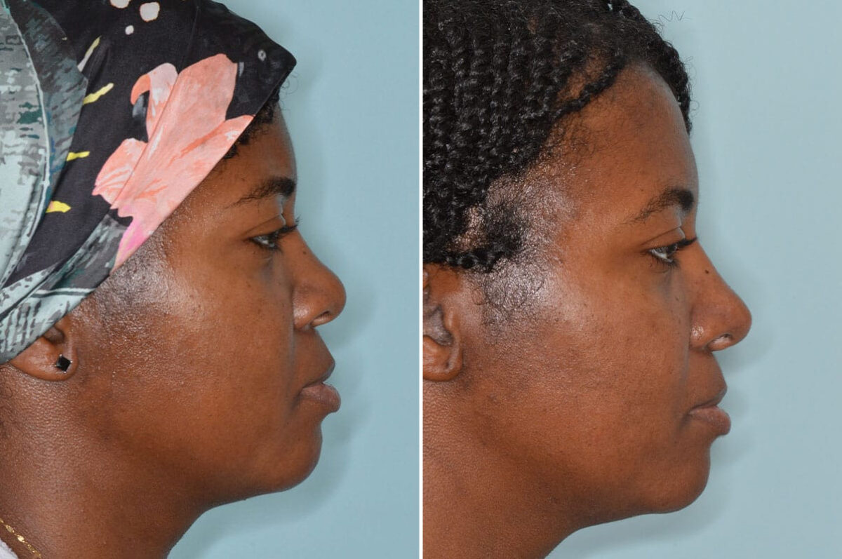 Ethnic Rhinoplasty Before and After Photos in Miami, FL, Patient 8364