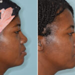 Ethnic Rhinoplasty Before and After Photos in Miami, FL, Patient 8364