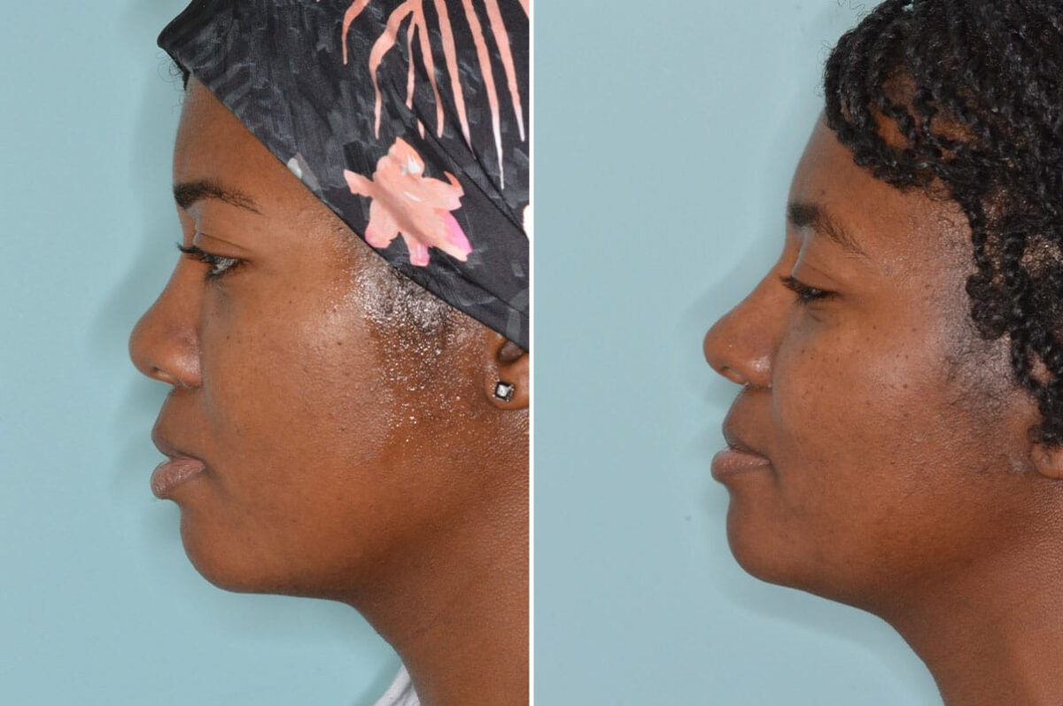 Ethnic Rhinoplasty Before and After Photos in Miami, FL, Patient 8364